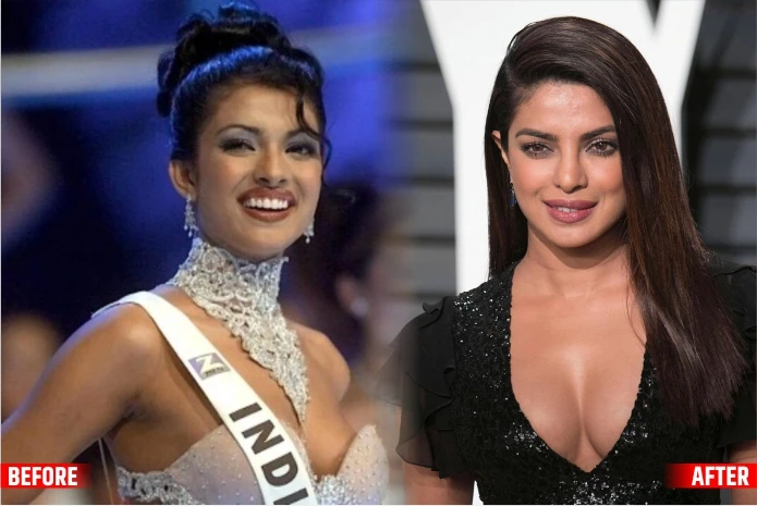 Priyanka Chopra The Btown Actresses Before and After Plastic Surgery