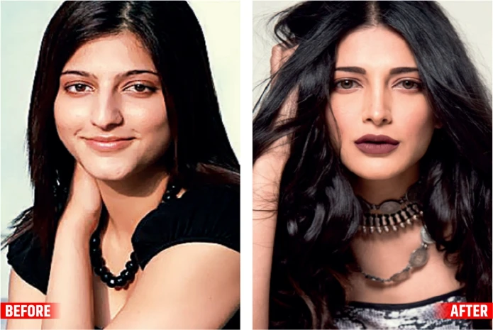 Shruti Hasan The Btown Actresses Before and After Plastic Surgery