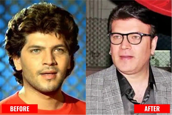 Aditya Pancholi: actor with dental implant