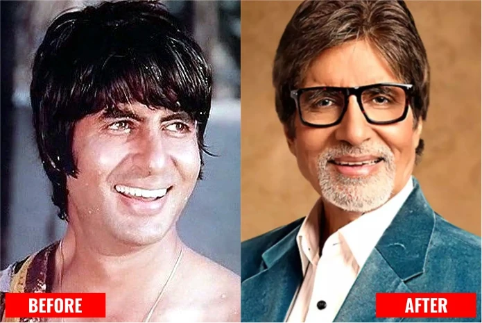 Amitabh Bachchan: Bollywood actors with Dental implants