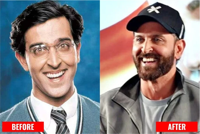 Hrithik Roshan with dental implant