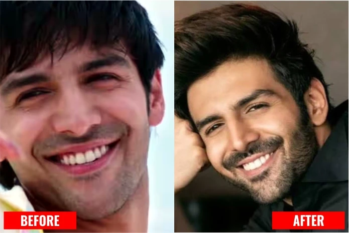 Kartik Aryan: Dental Implant