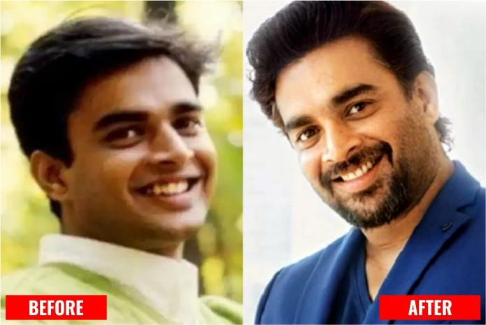 R Madhavan: Actor with Dental Implant