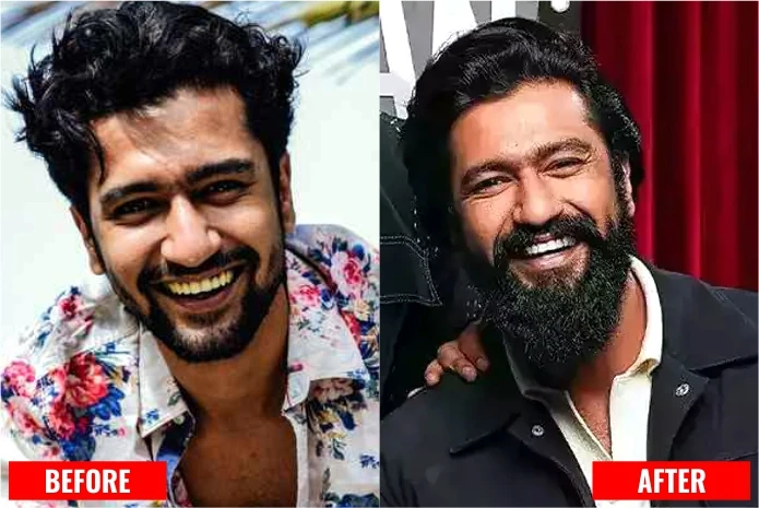 Vicky Kaushal: Celebrity dental implant before and after